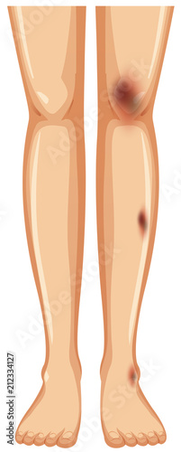 Pair of legs with bruises