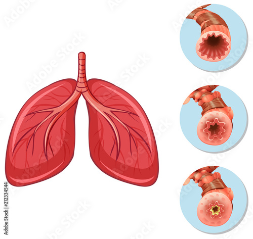 Stages of block airway to lungs