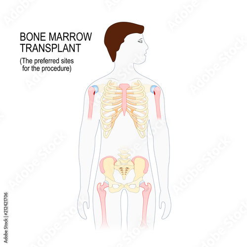 bone marrow transplant. The preferred sites for the transplantation procedure