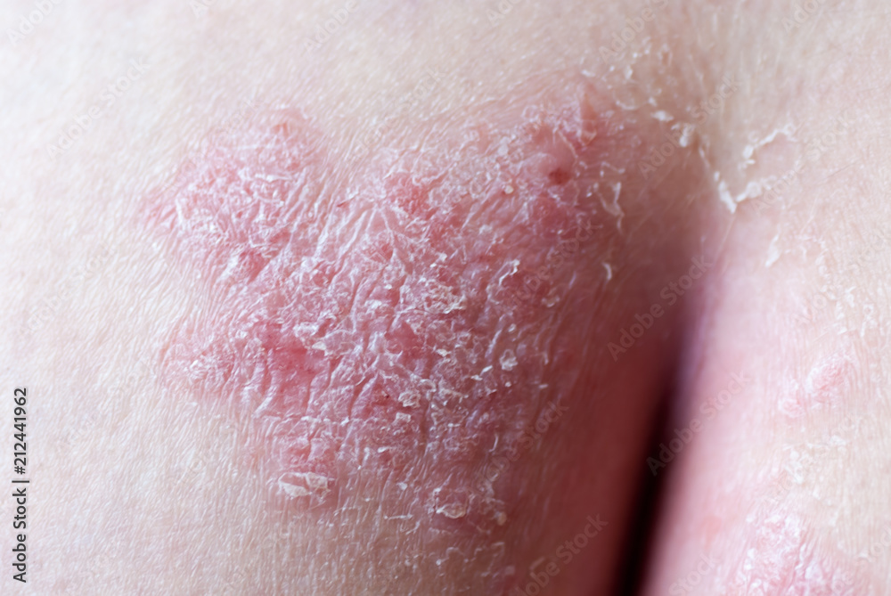 Fototapeta premium Psoriasis