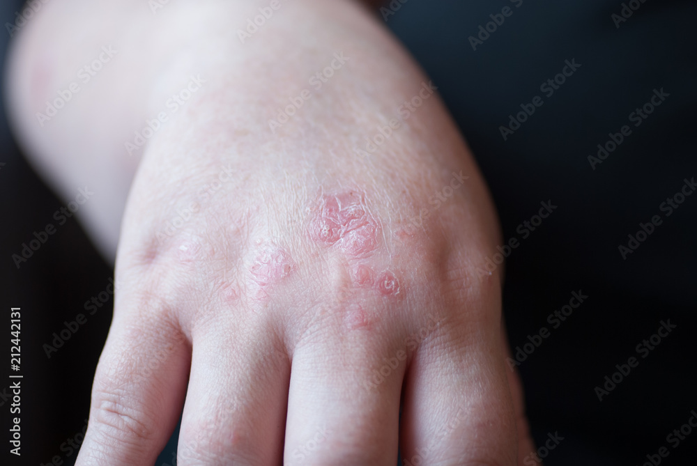 Fototapeta premium Psoriasis 