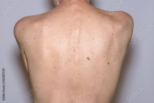 The back of a woman with many liver spots