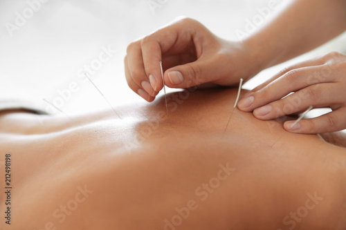 Young woman undergoing acupuncture treatment in salon, closeup photo