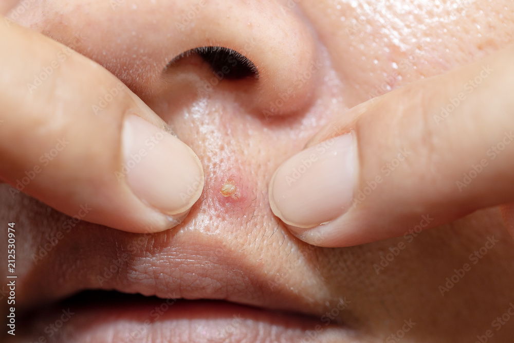 Hands squeezing acne on the lips for the health of women. Hands squeezing acne on the lips for the health of women.