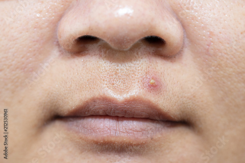 Acne inflammation above the lips Women's health concept