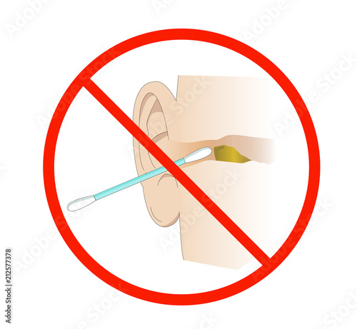 Cleaning the auditory canal with a cotton swab. Illustration with a forbidden sign, concept of prohibition and unhealthy habit. Removing earwax.