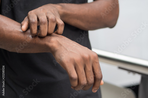 man suffering from itching skin; sick african man scratching his skin with allergy, rash, ringworm, tinea problem; health care, skin care, dermatology concept; adult african man, black man model. photo
