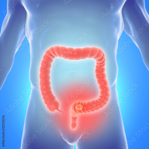 Fotografia 3d illustration of colorectal cancer