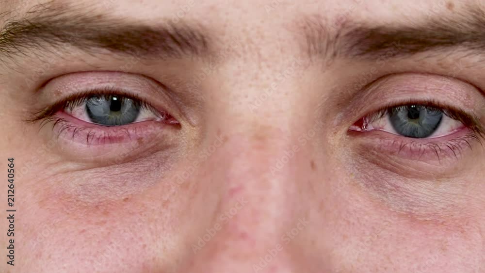 Close up of two annoyed red blood eyes of male affected by conjunctivitis or after flu, cold, allergy. Copy space for advertisement. Tired eyes after working at the computer. Close-up videos and macro