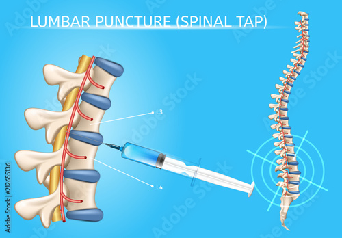 Lumbar Puncture Realistic Vector Medical Scheme