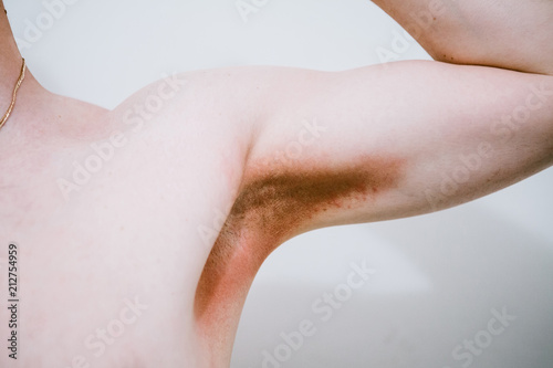 A man with a skin disease in the armpit area. Prickly heat.