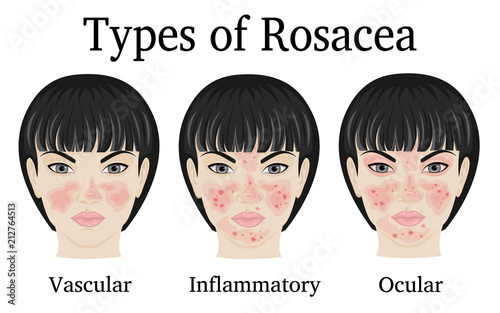 Three types of Rosacea - vascular, inflammatory and ocular for example depicted on the face of a young woman