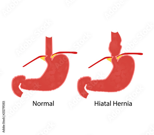 Hiatal hernia and normal anatomy of the stomach and esophagus