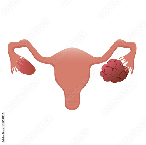 Polycystic ovary illustration photo