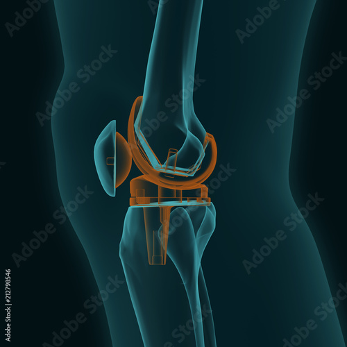 X-ray of a human knee in the lateral projection with knee replacement
