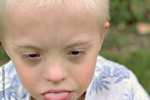 Defect,childcare,medicine and people concept- boy with down syndrome poses for a portrait outdoors.