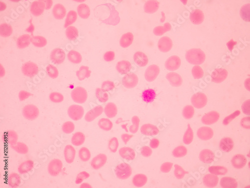 Wallpaper Mural Thalassemia blood smear abnormal red blood cells morphology. Torontodigital.ca