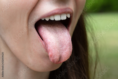 Female with tongue out of mouth showing Candida albicans infection