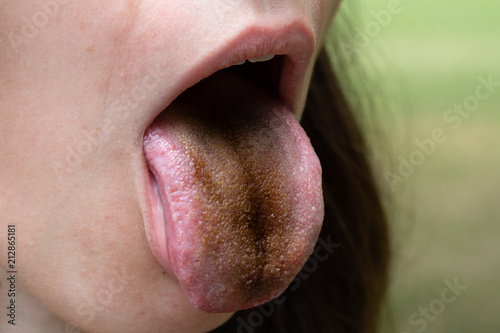 Girl with black tongue due to Enterobacter cloacae photo