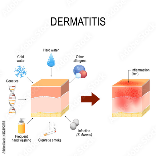 Atopic dermatitis (atopic eczema). factors that cause disease. cross-section of human skin photo