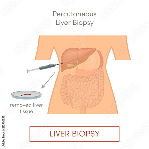 Percutaneous liver biopsy
