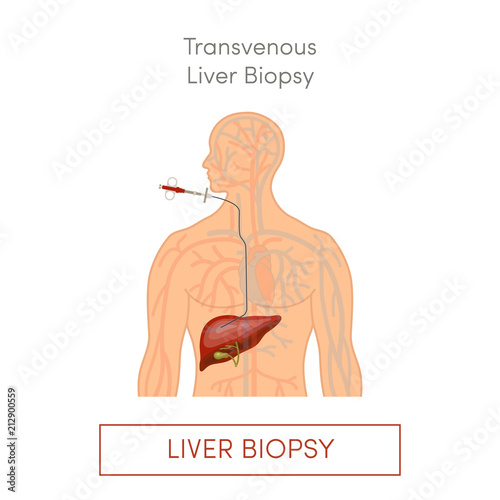 Transvenous liver biopsy photo