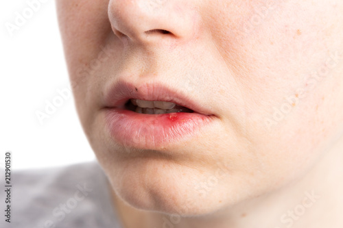 Pustule ulceration or aphtae on woman lip. photo