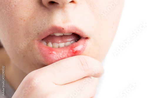 Schilderij op canvas Aphtha on woman lower lip.