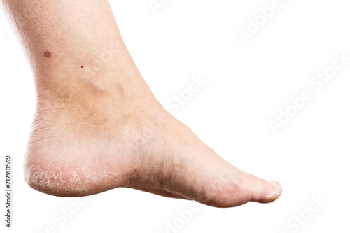 Woman foot with cracked heel.