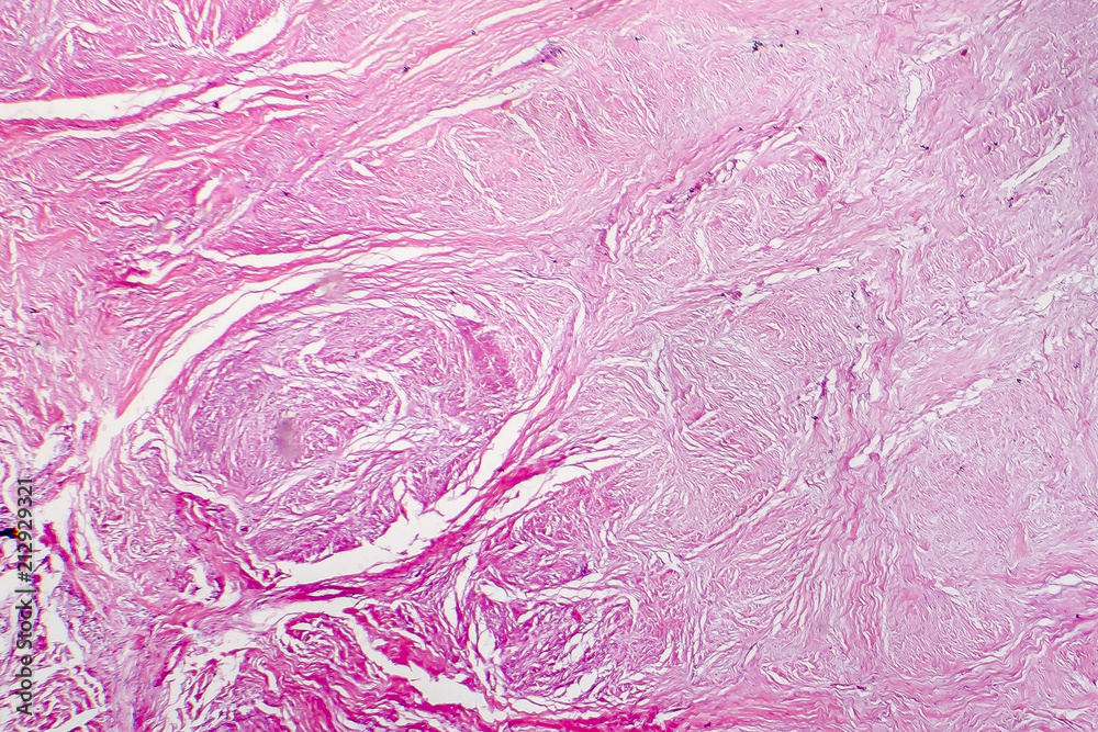 Light micrograph of scar tissue. Photo under microscope of a scar