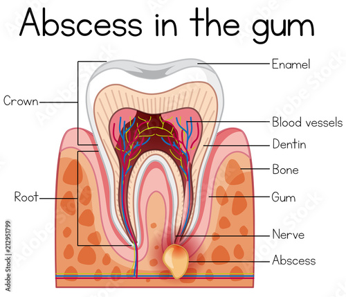 Abscess in the Gum Diagram