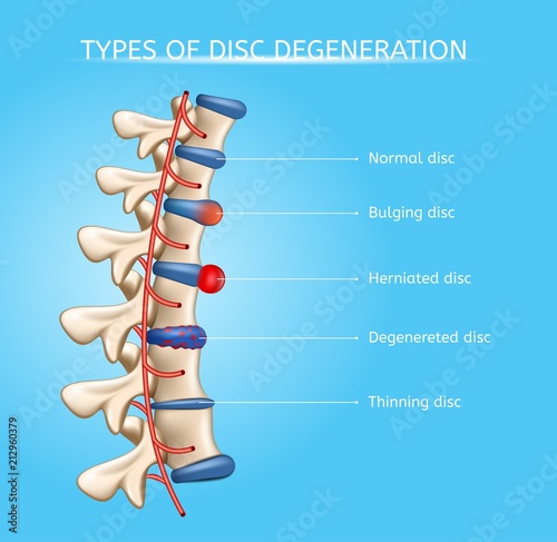 Intervertebral Disc Degeneration Types Vector photo