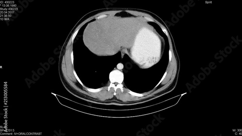 tüm batın tomografisi ,ilaçlı tomografi  photo