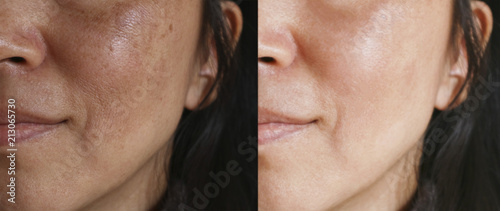 Before and after facial treatment concept. Face with melasma and brown spots and open pores.