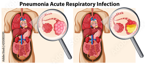 Pneumonia Acute Respiratory Infection