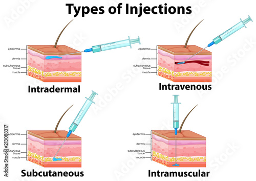 A Set of Type of Injections photo