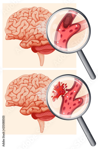 Human Brain and Hemorrhagic Stroke