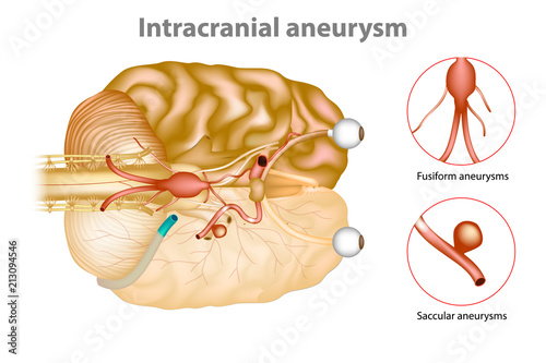 
Intracranial aneurysm or brain aneurysm.
 photo
