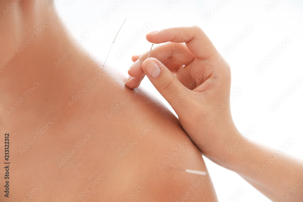 Young woman undergoing acupuncture treatment in salon, closeup - obrazy, fototapety, plakaty 