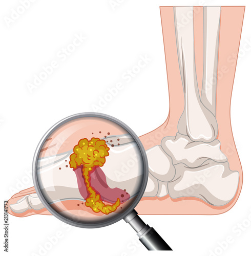 Gout In Human Foot photo