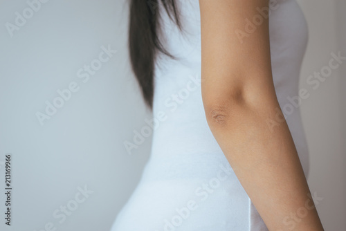 Woman with dry skin on elbow and arm,Body and health care concept