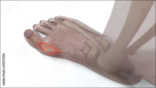 Hallux valgus x-ray anatomical vision