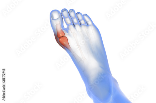 Hallux valgus x-ray anatomical vision