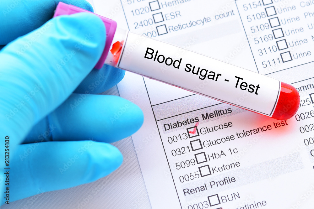 Blood sample tube with laboratory requisition form for glucose test, diabetes diagnosis Stock