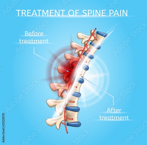 Treatment of Spine Pain Realistic Vector Chart