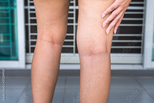 Varicose vein on the woman leg