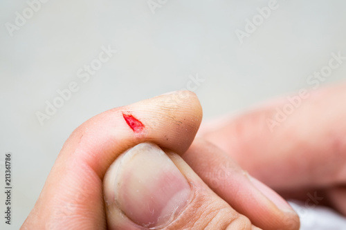Man cut off his finger It’s bleeding and feel painful.