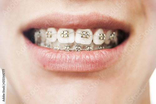 Dental concept. Braces on the upper and lower jaw in the adolescent. The look of the braces on the teeth is close