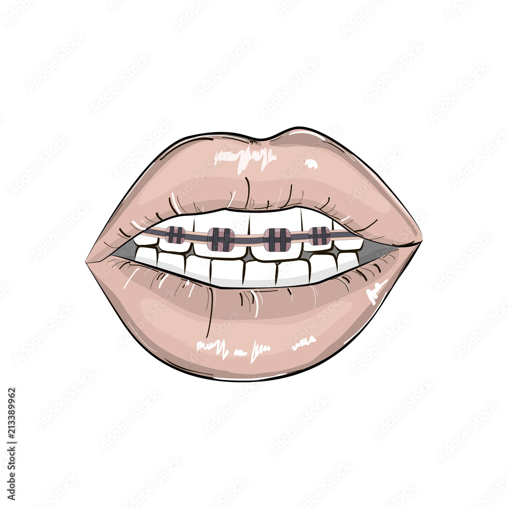 Grafika wektorowa Stock Sexy red lips braces illustration. Erotic