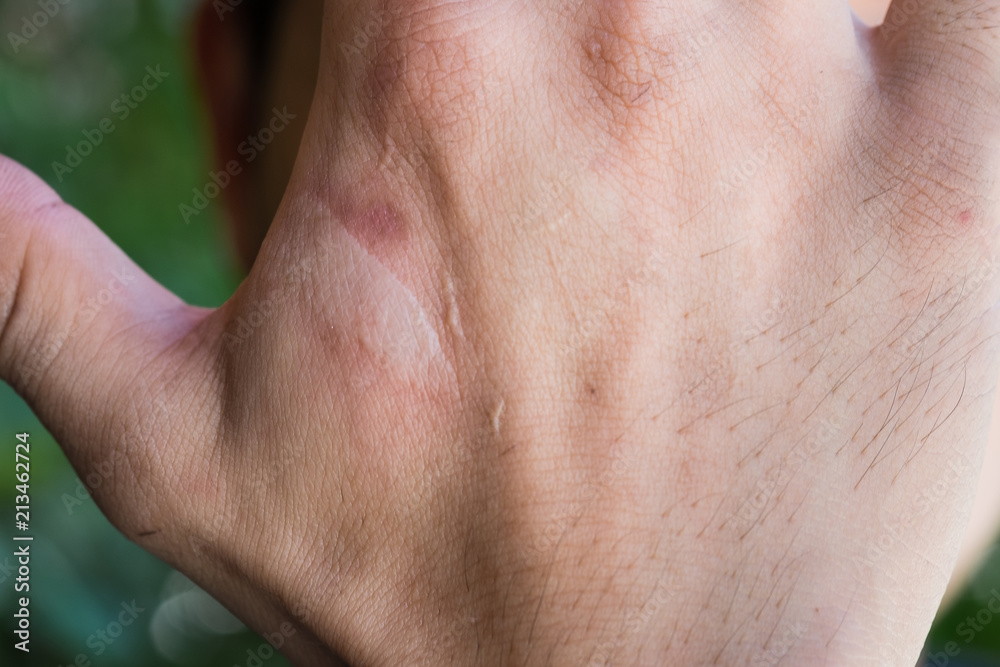 Fototapeta premium burning pain wound from burn on man's hand,